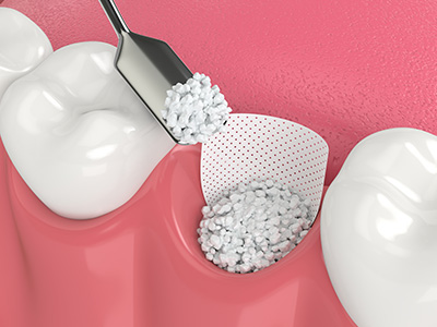 Vernon Woods Dental   Implant Center | Teeth-In-A-Day  , Dental Fillings and Dental Sealants