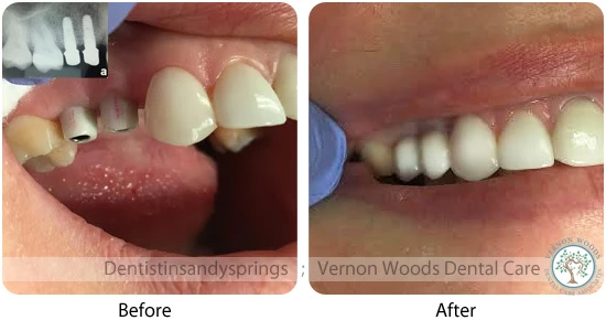 Vernon Woods Dental Implant Center | Digital Radiography, Oral Exams and Invisalign reg