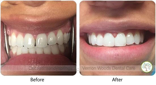 Vernon Woods Dental & Implant Center | Intraoral Camera, Fluoride Treatment and Teeth-In-A-Day®