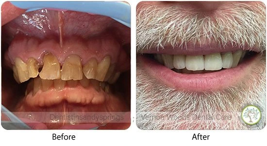 Vernon Woods Dental & Implant Center | Root Canals, Bone Grafts and Piezo Ultrasonic Scaler