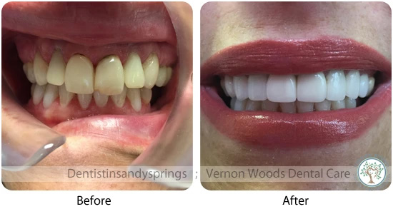 Vernon Woods Dental Implant Center | Ceramic Crowns, Veneers and Bone Grafts