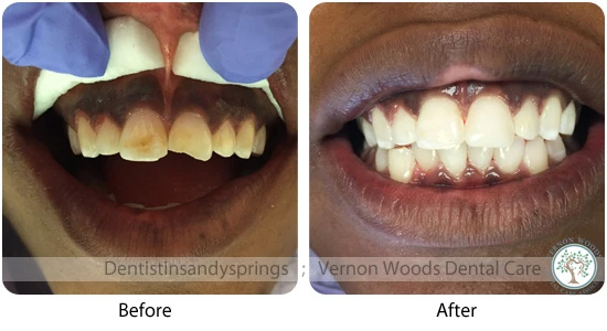 Vernon Woods Dental Implant Center | Invisalign reg , Extractions and Implant Dentistry